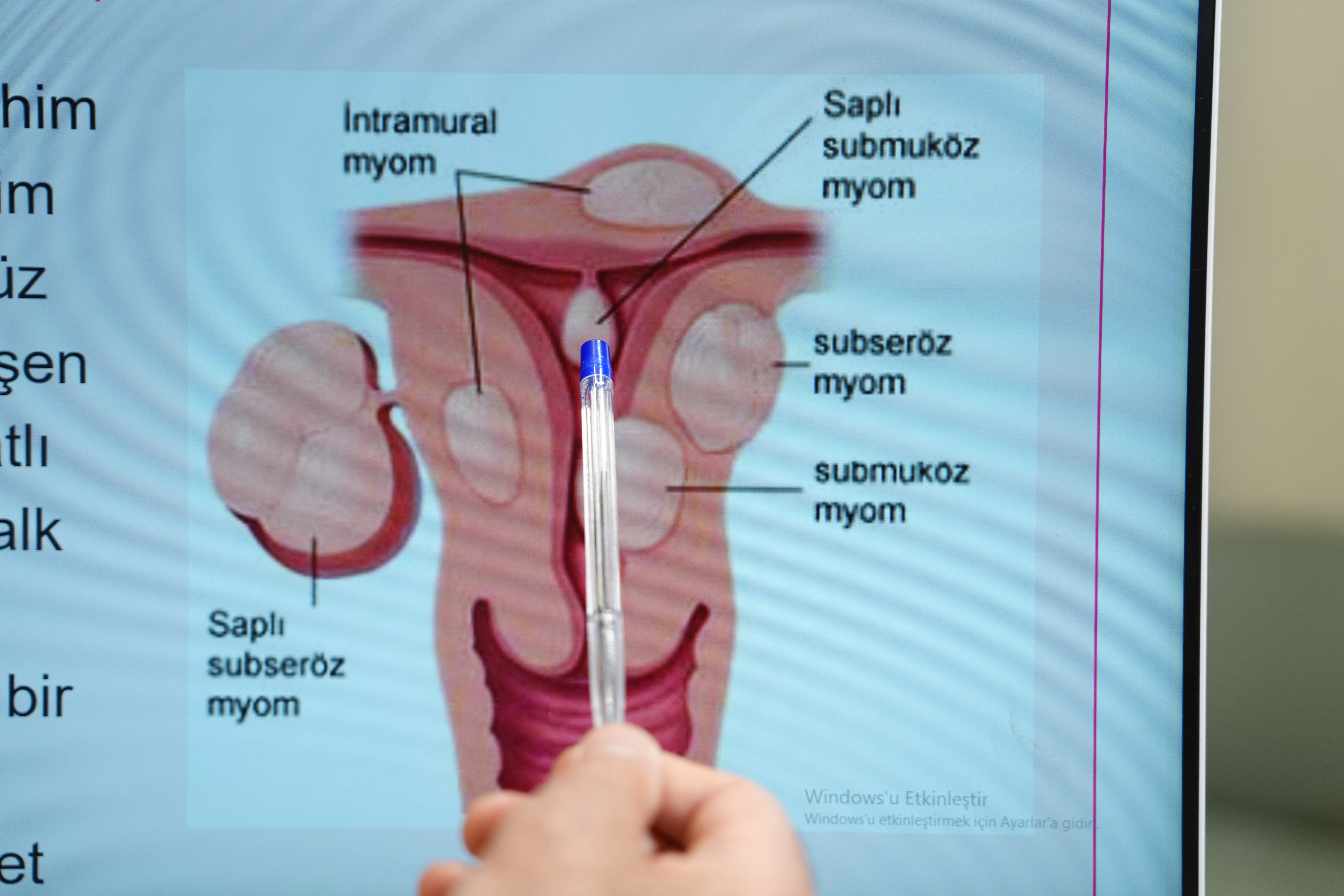 Her 3 kadından birinin ortak sorunu miyom!