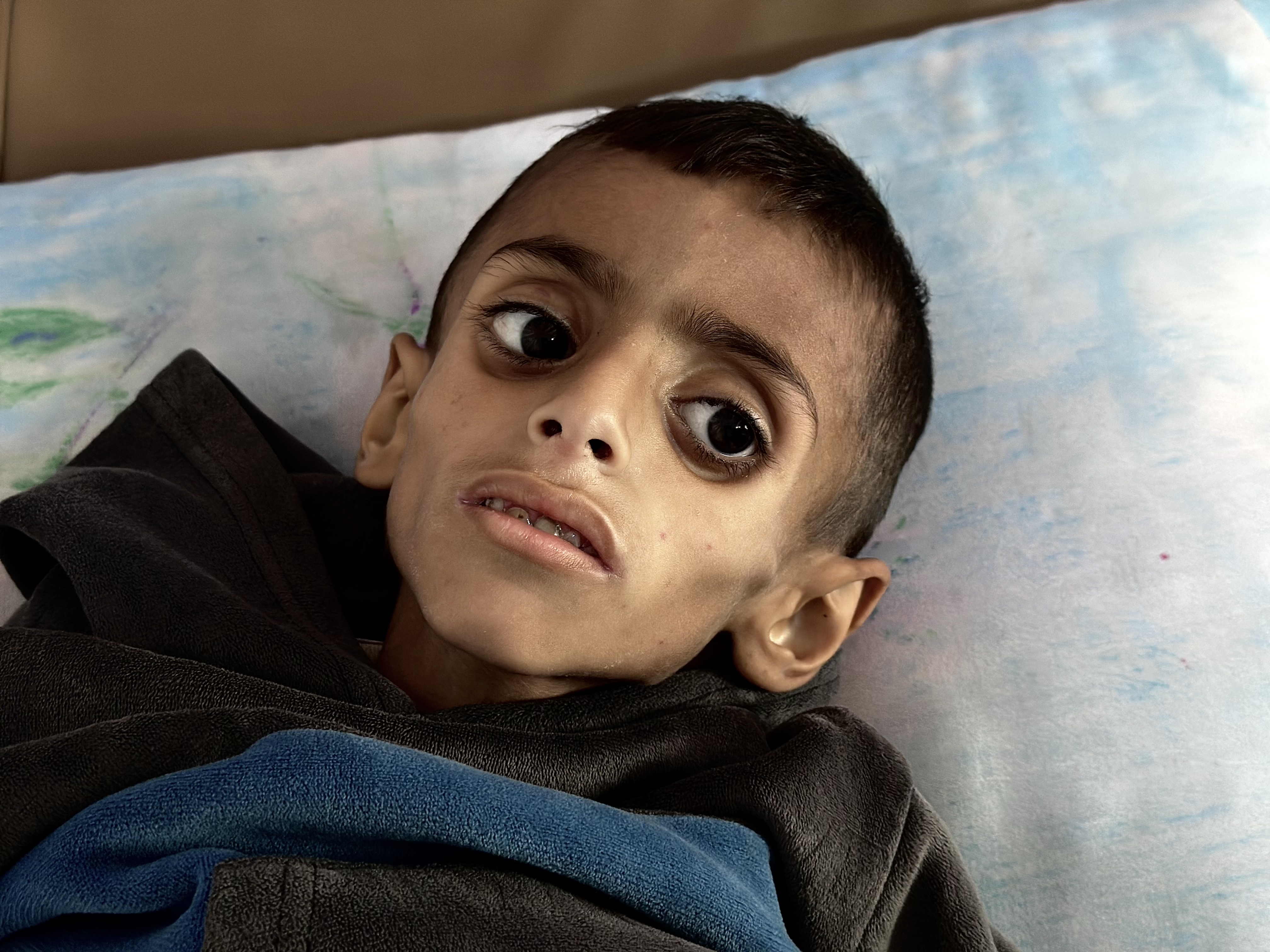 AA-20250425-37743896-37743886-ISRAIL_ABLUKASI_NEDENIYLE_GAZZEDE_COCUKLARIN_YETERSIZ_BESLENME_VAKALARI_GIDEREK_ARTIYOR