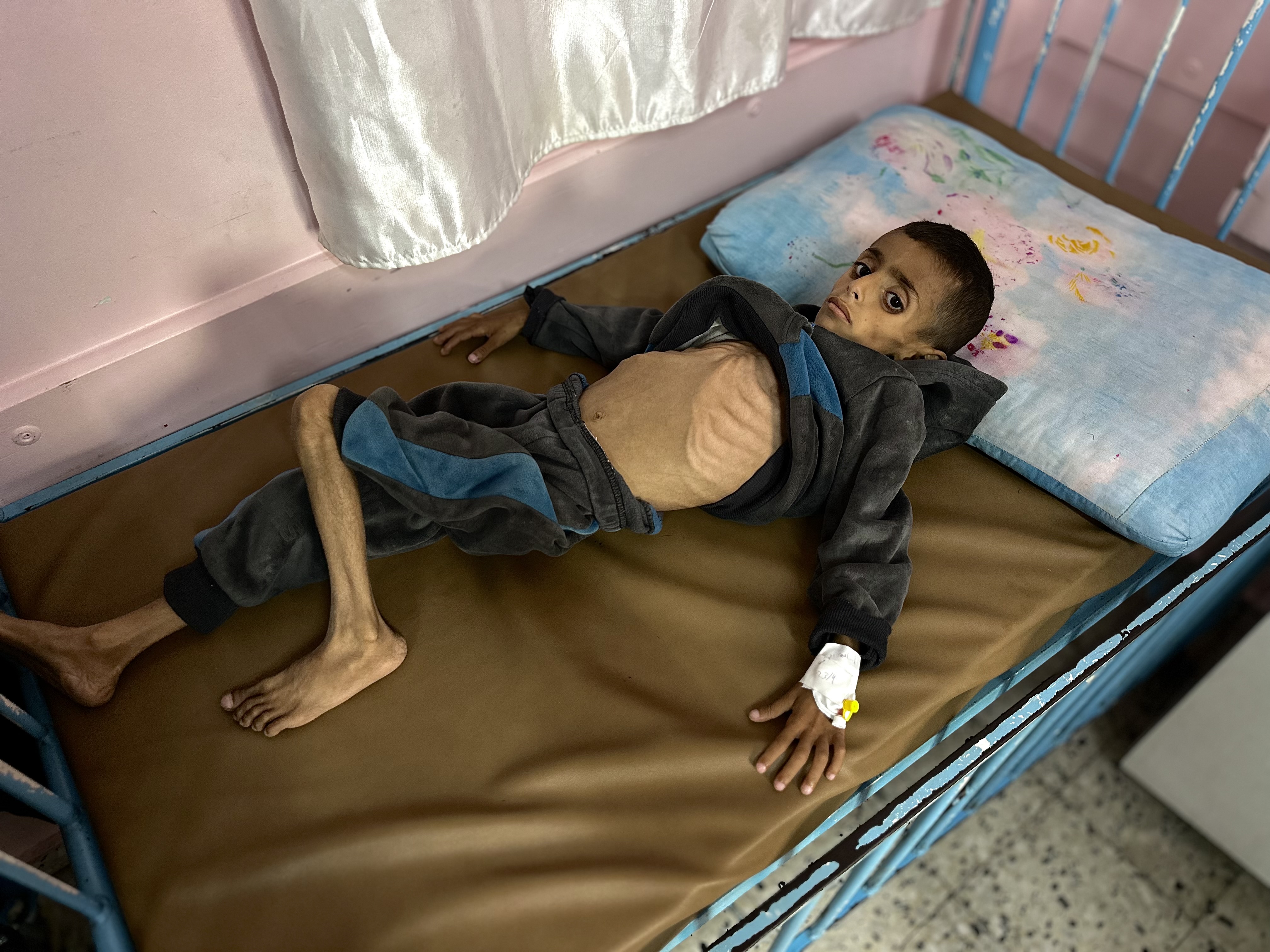 AA-20250425-37743896-37743892-ISRAIL_ABLUKASI_NEDENIYLE_GAZZEDE_COCUKLARIN_YETERSIZ_BESLENME_VAKALARI_GIDEREK_ARTIYOR