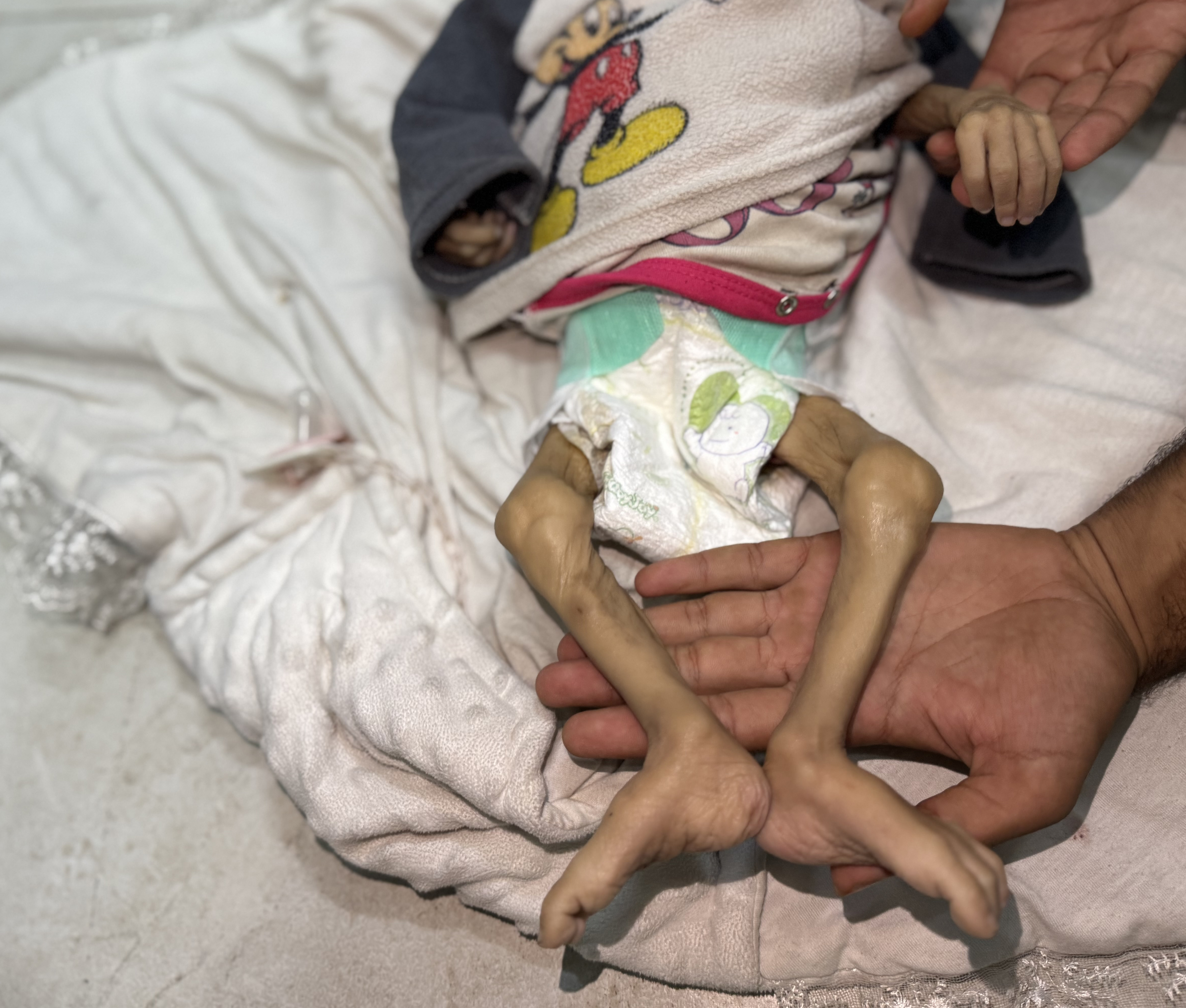 AA-20250725-38665378-38665363-GAZZEDE_ACLIK_VE_YETERSIZ_BESLENME_CAN_ALMAYA_DEVAM_EDIYOR