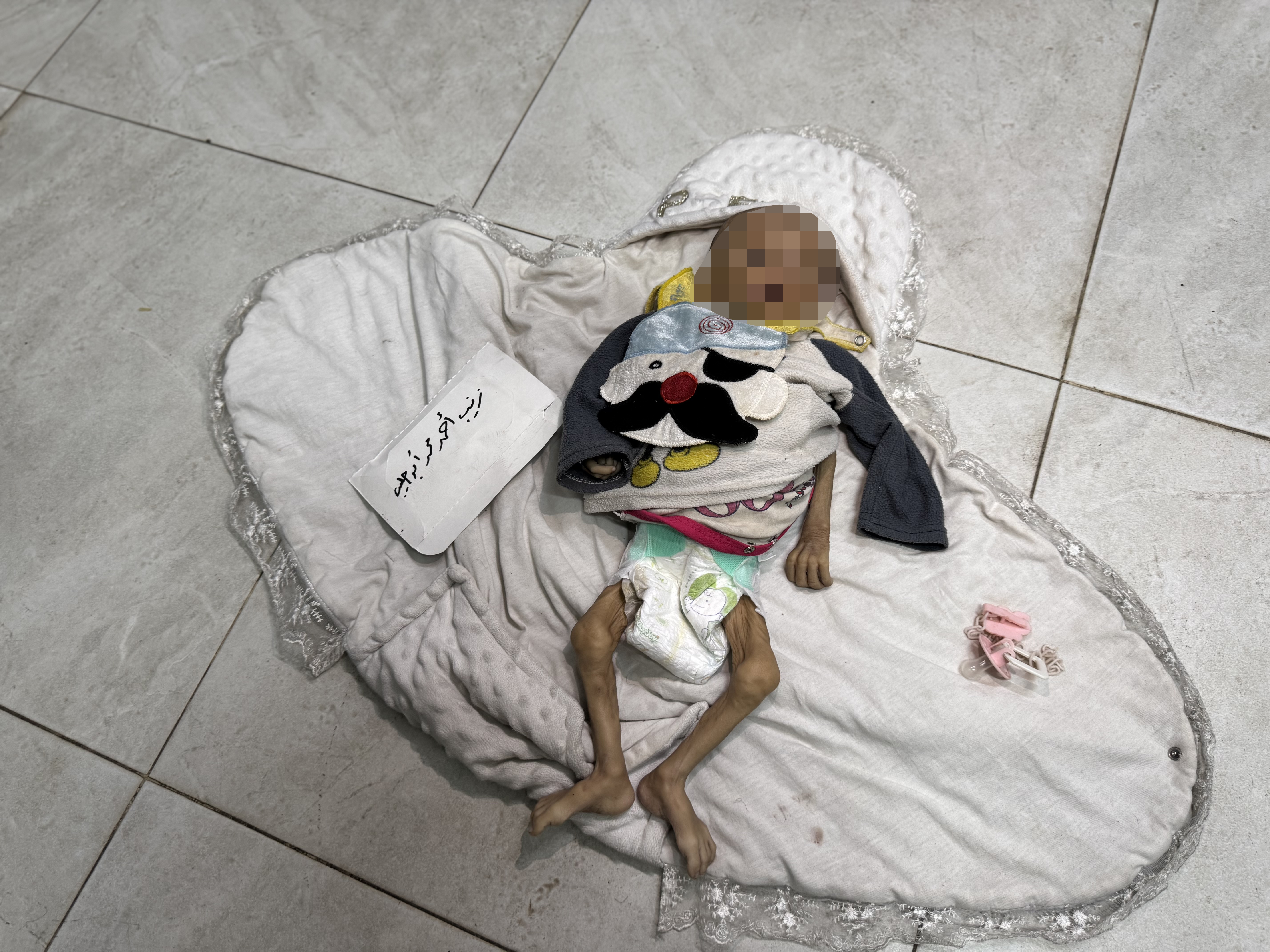 AA-20250725-38665378-38665365-GAZZEDE_ACLIK_VE_YETERSIZ_BESLENME_CAN_ALMAYA_DEVAM_EDIYOR