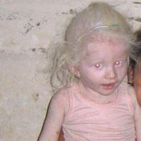Albino kızın kol ve bacaklarını kopardılar