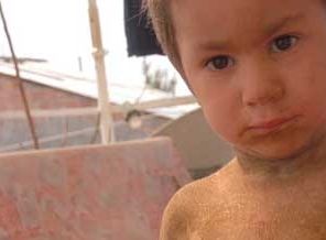 Timsaha benzeyen Dila iyileşti