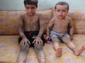 Balık derili çocuklar !!!