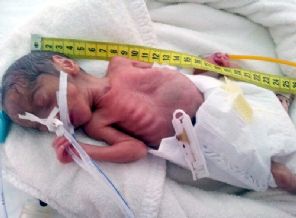 590 gram dogan parmak bebek 2400 grama ulasinca taburcu edildi timeturk haber