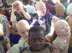 Türkiye, siyah Afrika'nın beyaz çocukları için 'Albino köyü' kuruyor