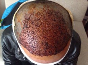 Uzmanlardan saç ekiminde 'merdiven altı' uyarısı