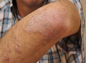 Sedef hastalarına müjde