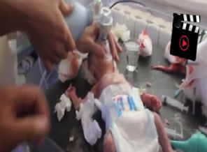 Yaralı bebeğin hayata tutunma çabası