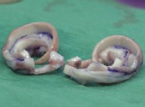 Çocuğa kaburgadan kulak