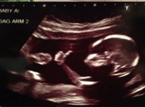 Anne karnında fenomen oldu