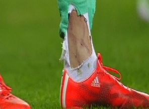 Kalecinin ayağı parçalandı