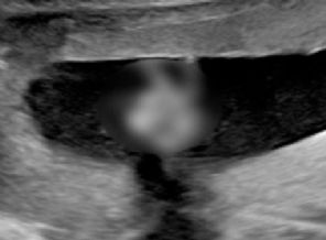 Anne karnındaki bebekten 'zafer işareti'