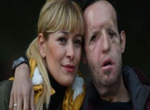 Yüz nakli olan Recep Sert hastaneye kaldırıldı