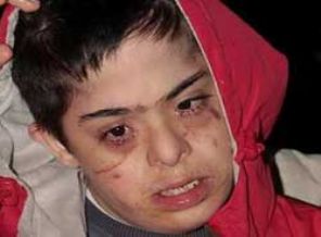 Down sendromlu çocuğa dayak iddiası